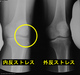 （交通事故・実例）　左膝外側側副靱帯損傷　12級7号