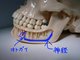 インプラントのリスク　下歯槽神経