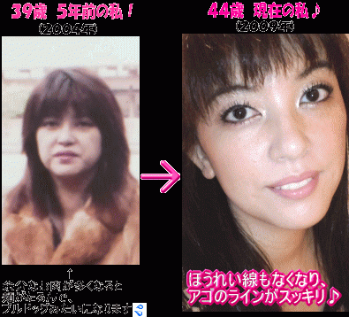 美容整形手術以外では治らないと言われた顔が自力で劇的若返り アンチエイジング美容家 ｎａｎａ ４７歳 ４人の子の母 ｎａｎａのビフォーアフター画像 ３９歳 ４４歳 このページを閉じる ヘルプ 運営会社 Copyright En Factory Inc