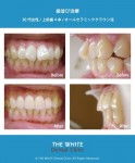 歯並び治療（セラミック法）