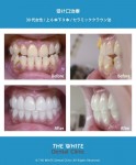 受け口と歯の色治療（セラミック法）