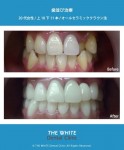 歯並び治療（セラミック法）