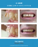 出っ歯治療（セラミック法）