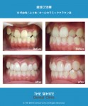 歯並び治療（セラミック法による矯正）