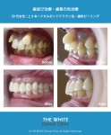セラミック法による歯並び治療