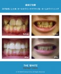 セラミック法による歯並び治療とホワイトニング