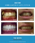 セラミック法による歯並び治療とホワイトニング