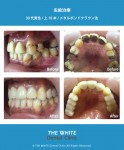 保険の歯の変色や虫歯治療