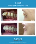 出っ歯の短期間治療（セラミック法）