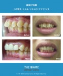 歯並び治療（セラミック法による短期間矯正）